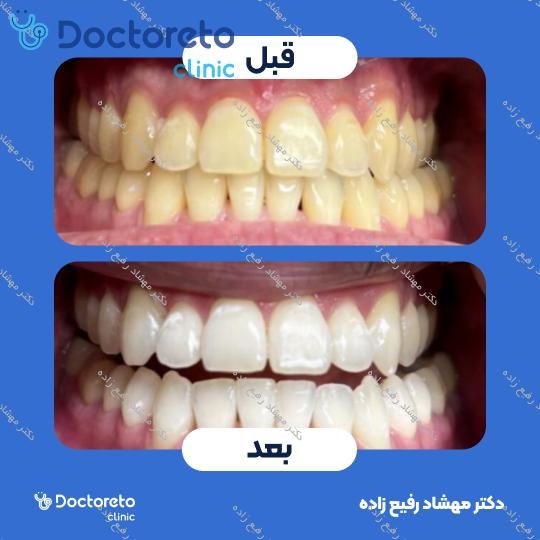 جرم گیری دندان با بروساژ🦷