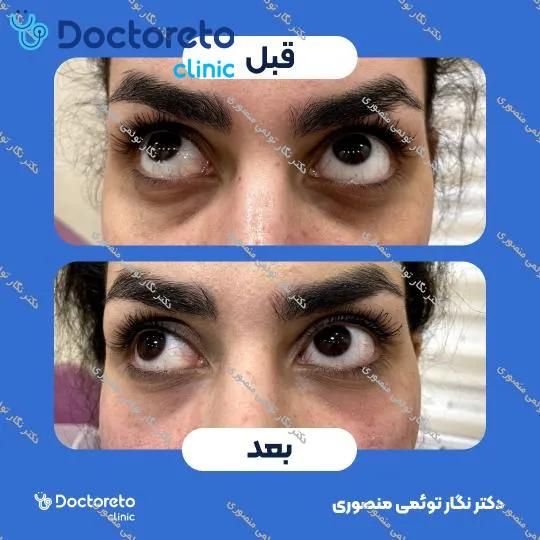 تزریق ژل زیر چشم