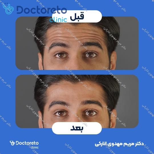 تزریق بوتاکس صورت
