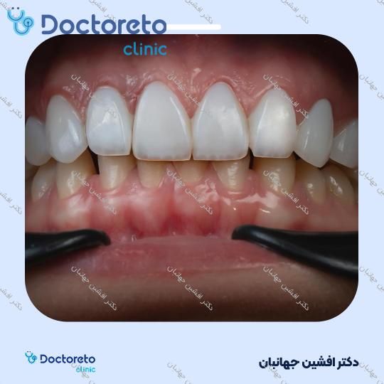 پر کردن دندان