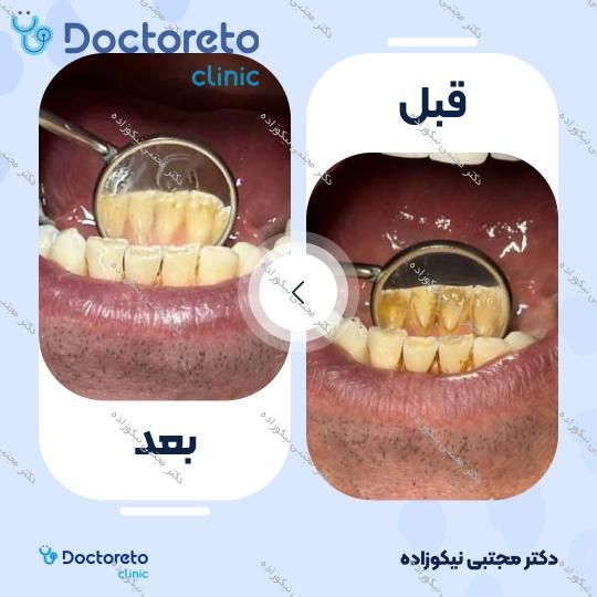 جرم گیری دندان با بروساژ🦷