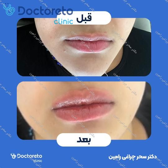 تزریق ژل لب