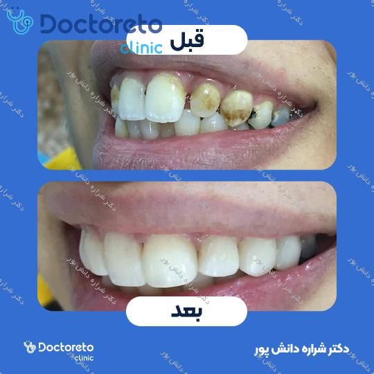 جرم گیری دندان با بروساژ 🦷