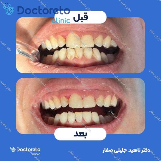 جرم گیری دندان با بروساژ🦷