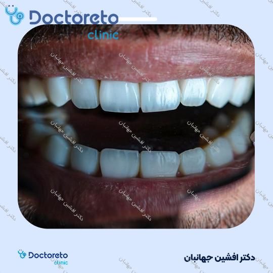 روکش دندان (هر واحد)