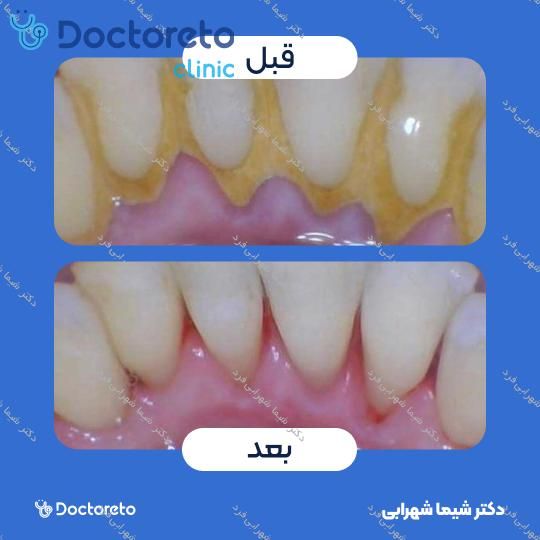 جرم گیری دندان با بروساژ 🦷