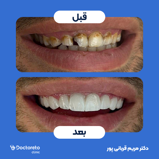کامپوزیت دندان (هر واحد)