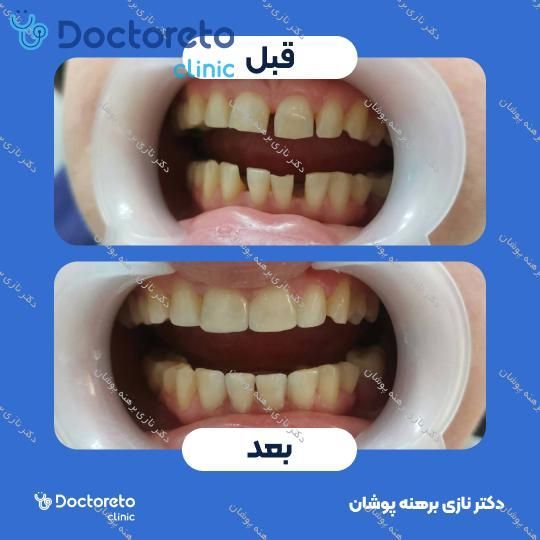 جرم گیری دندان با بروساژ🦷