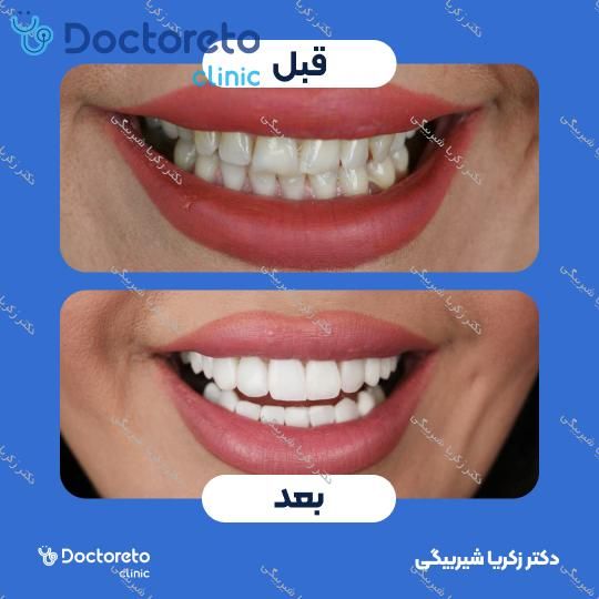 ونیر کامپوزیت (هر واحد)