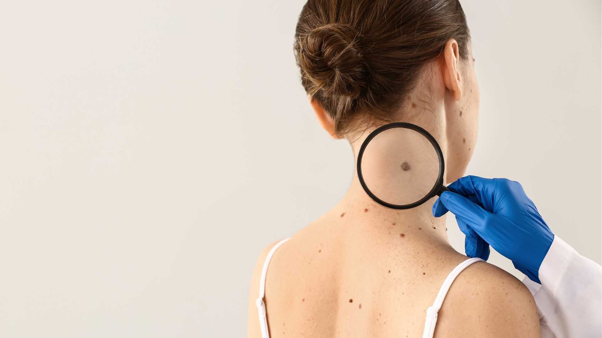 برداشتن خال با لیزر CO2 (هر عدد)