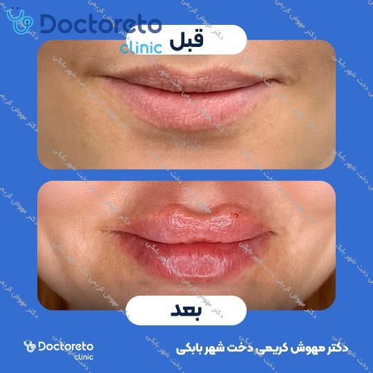 تزریق ژل لب