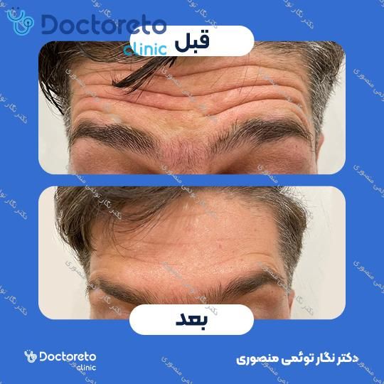 تزریق بوتاکس صورت (پیشانی، خط اخم، پنجه کلاغی)💉