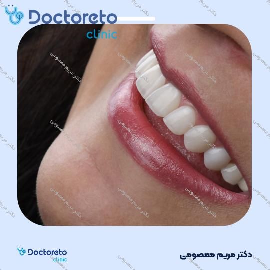 ونیر کامپوزیت (هر واحد)