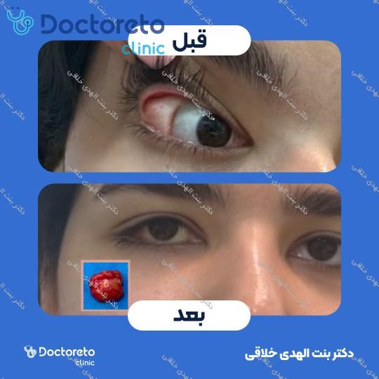 اصلاح عدم تقارن پلک ها با جراحی مولرکتومی (بدون بخیه)