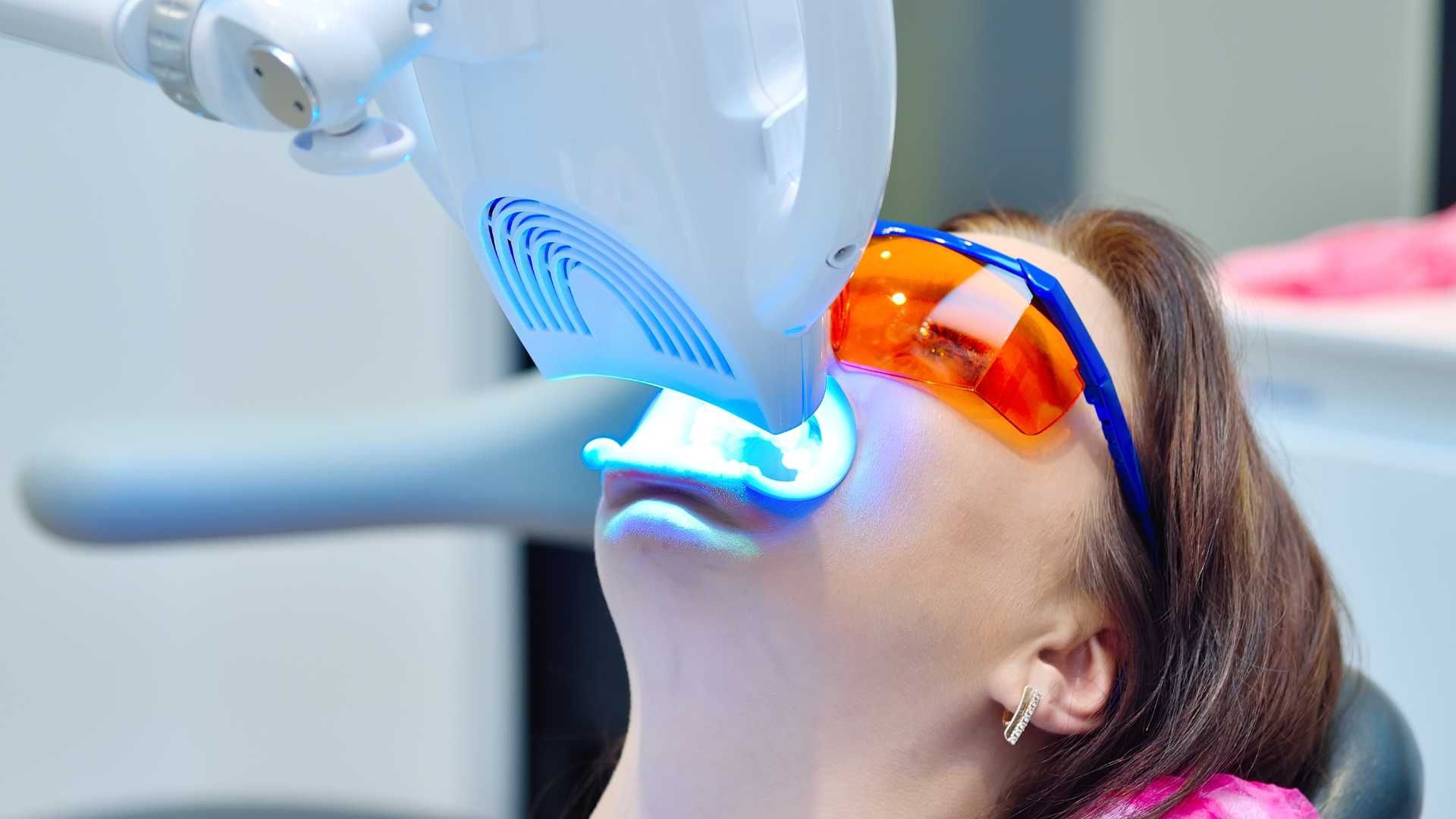 آفیس بلیچینگ (سفید کردن دندان) دو فک با مواد برزیلی