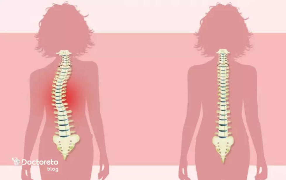درمان بیماری‌های ستون فقرات (تنگی کانال نخاع) با لیزر پرتوان (هرجلسه)
