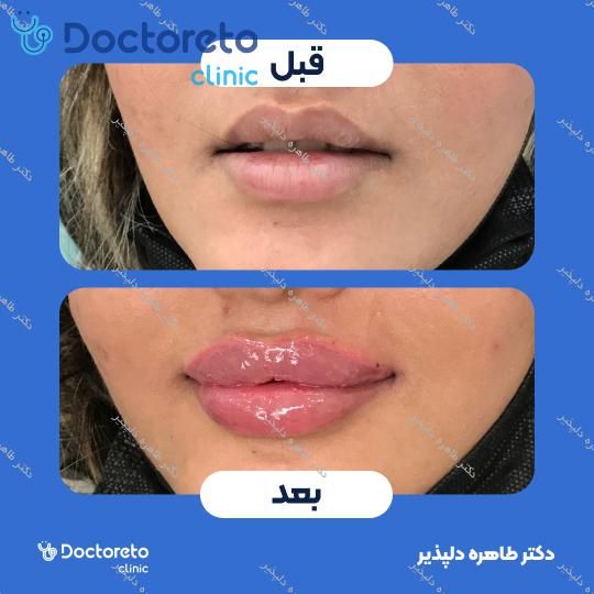 تزریق ژل لب