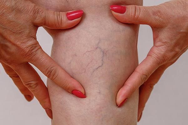 درمان واریس