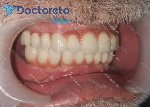 ایمپلنت دندان با روکش (هر واحد)