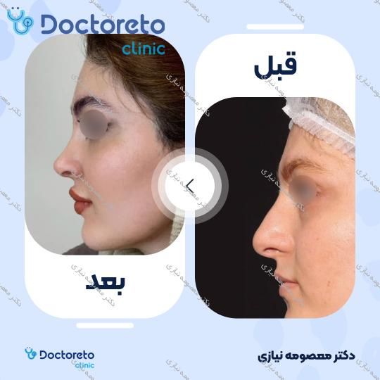 عمل زیبایی بینی (رینوپلاستی)