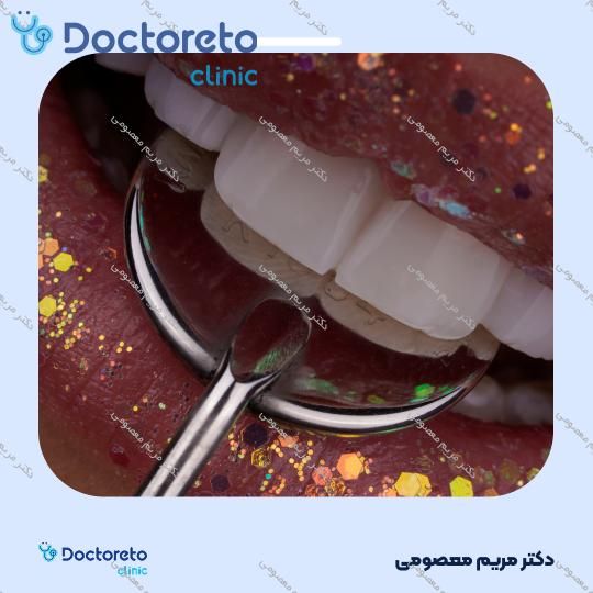 لمینت دندان (هر واحد)