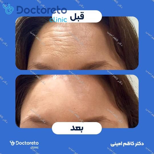 تزریق بوتاکس صورت (پیشانی، خط اخم، پنجه کلاغی)💉