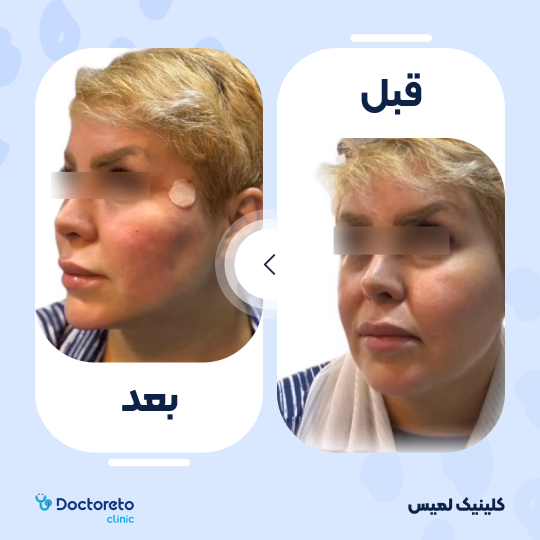 تزریق ژل خط خنده