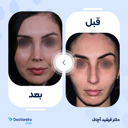 عمل جراحی زیبایی بینی (رینوپلاستی)