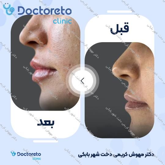 تزریق ژل لب