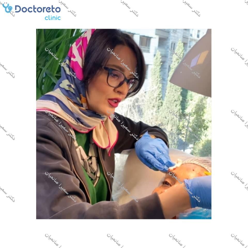 تزریق بوتاکس صورت (پیشانی، خط اخم، پنجه کلاغی)💉