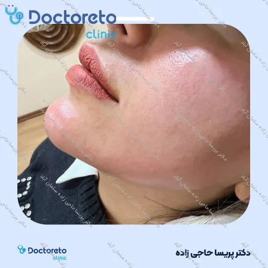 تزریق ژل چانه