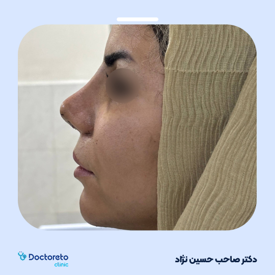 عمل زیبایی بینی استخوانی (رینوپلاستی)