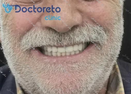 ایمپلنت دندان با روکش (هر واحد)