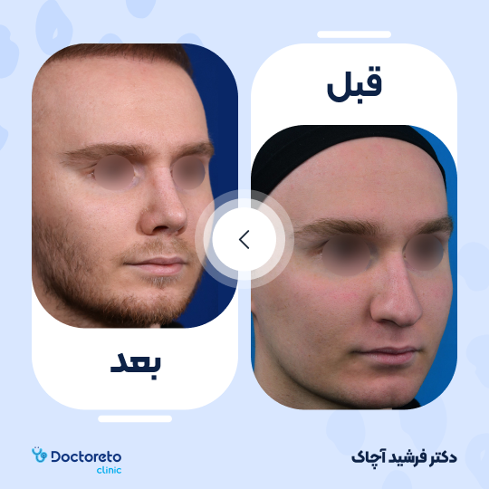 عمل جراحی ترمیمی زیبایی بینی (رینوپلاستی)