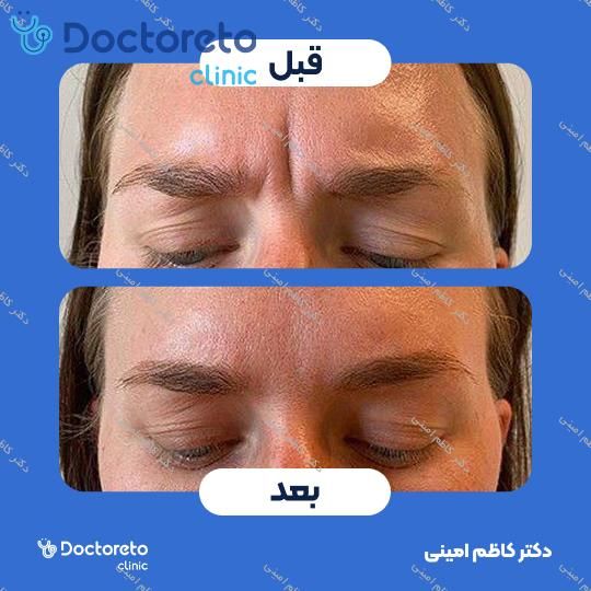 تزریق بوتاکس صورت (پیشانی، خط اخم، پنجه کلاغی)💉