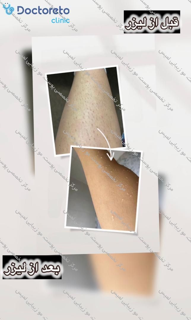 لیزر موهای زائد با دستگاه ایلایت اسکار
