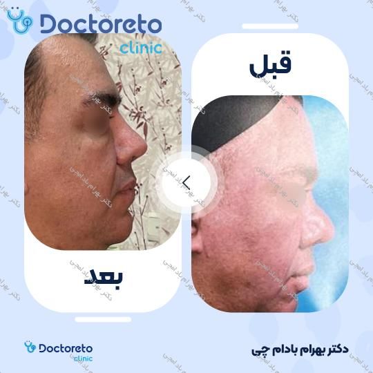 عمل زیبایی بینی گوشتی (رینوپلاستی)