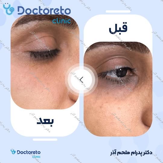 تزریق ژل زیرچشم