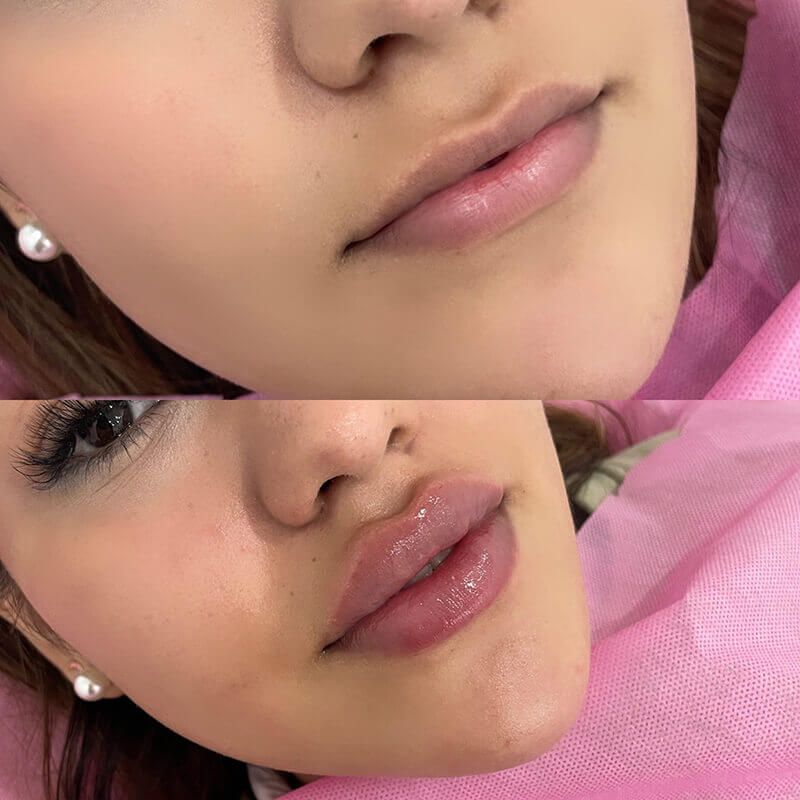 تزریق ژل لب