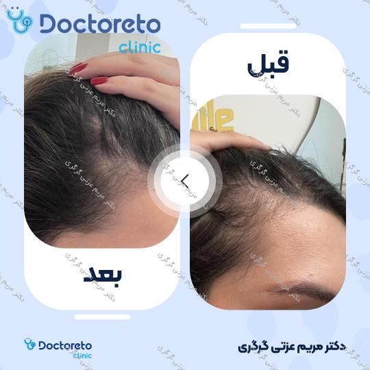 تزریق هیر فیلر مو جهت قطع ریزش مو