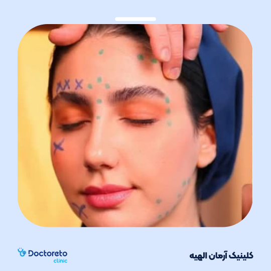 تزریق بوتاکس صورت (پیشانی، خط اخم، پنجه کلاغی)💉