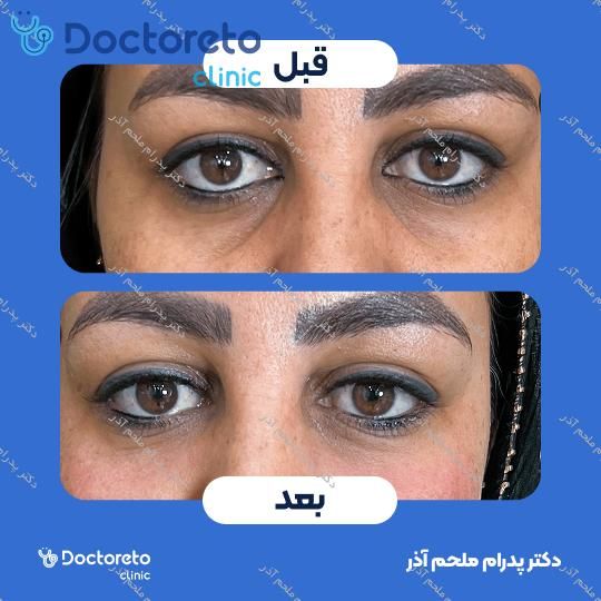 تزریق ژل زیرچشم