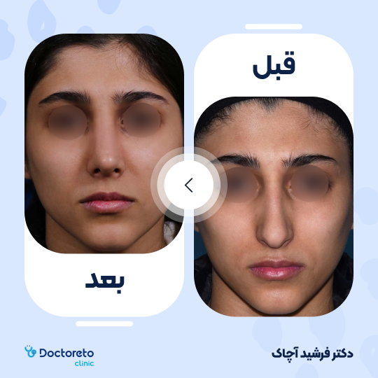 عمل جراحی ترمیمی زیبایی بینی (رینوپلاستی)