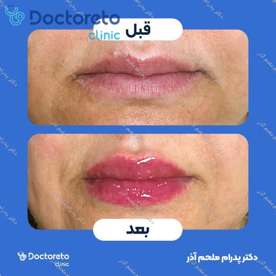 تزریق ژل لب