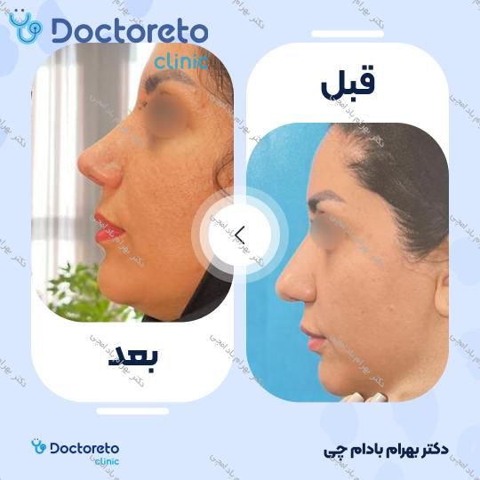 عمل زیبایی بینی گوشتی (رینوپلاستی)