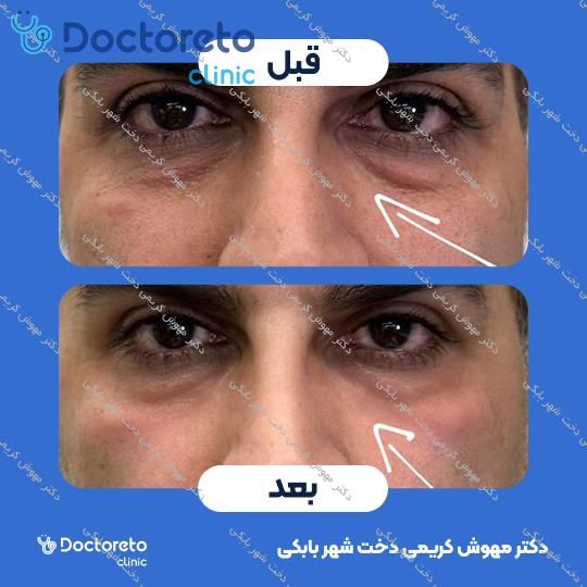 تزریق ژل زیر چشم