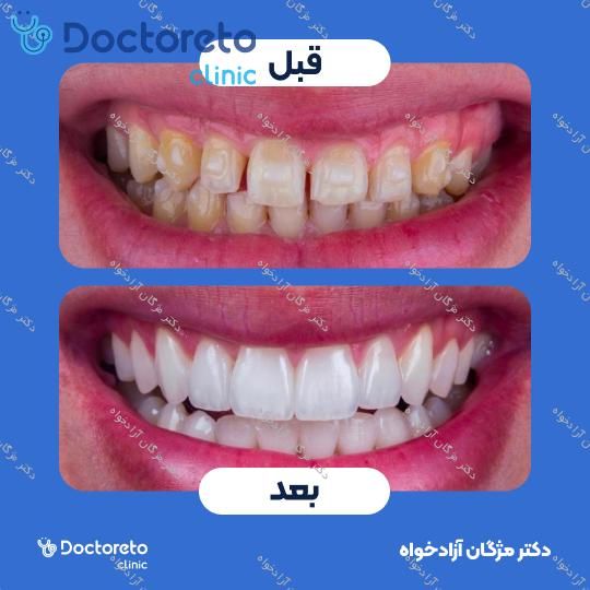 لمینت سرامیکی دندان (هر واحد)