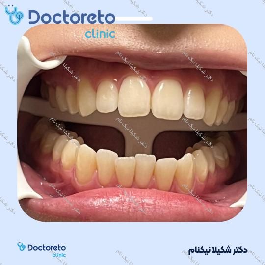 بلیچینگ دندان (سفید کردن دندان)