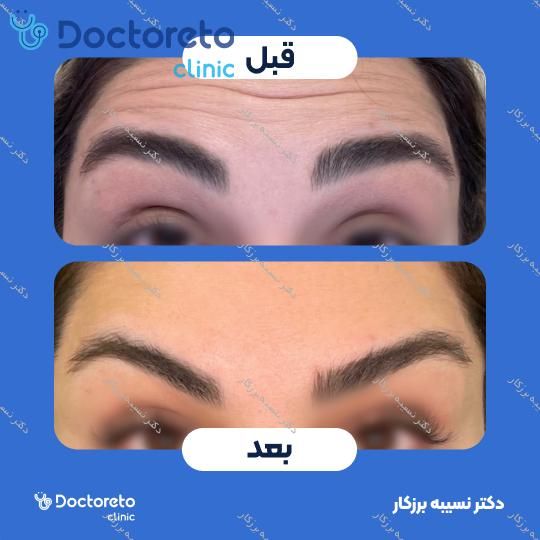 تزریق بوتاکس صورت (پیشانی، خط اخم، پنجه کلاغی)💉
