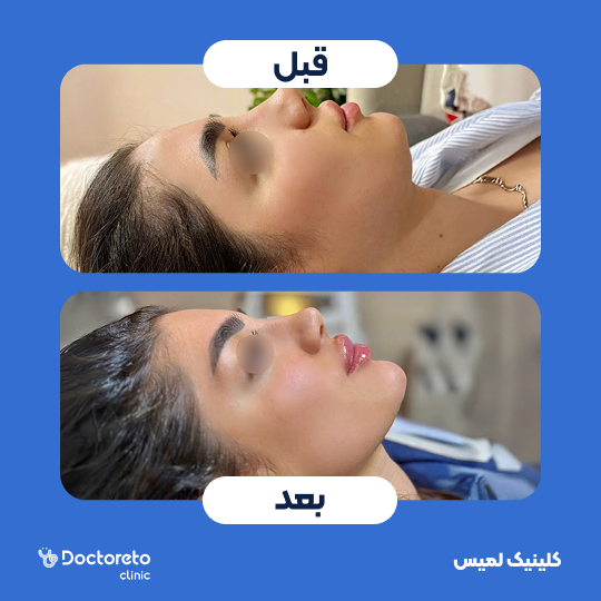 تزریق ژل لب